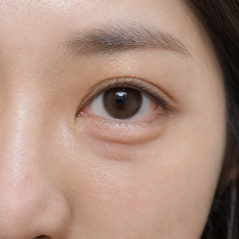 볼록한 눈밑 지방 클로즈업